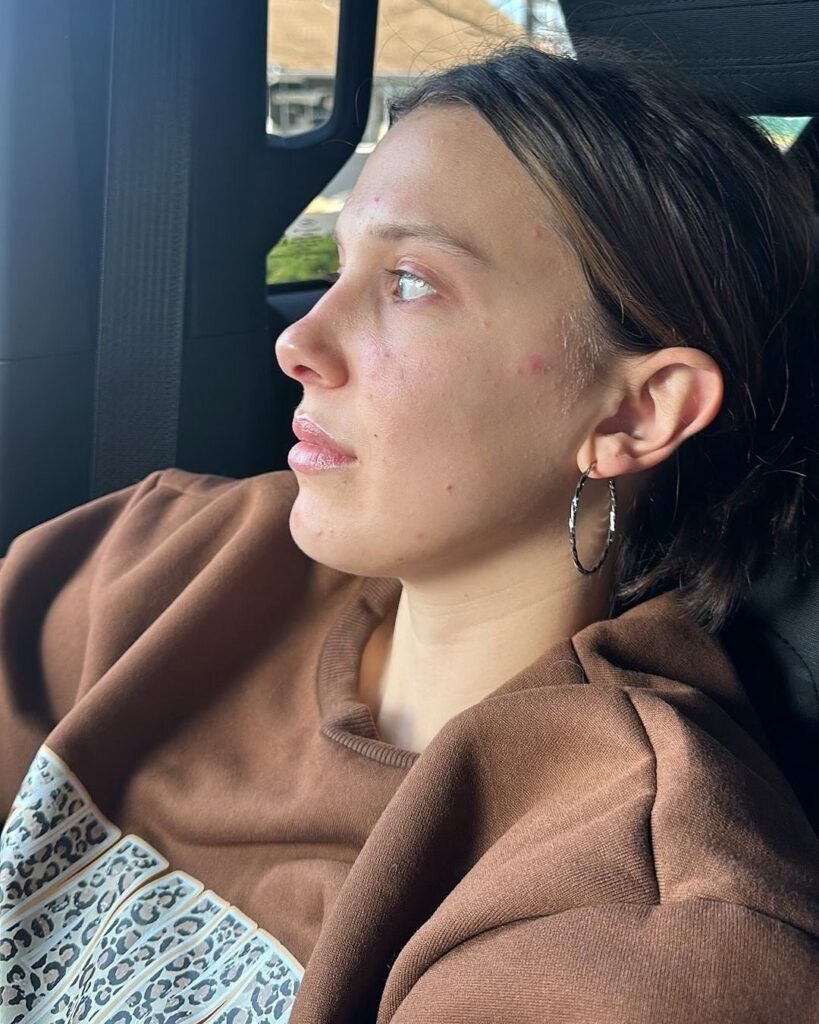 Millie Bobby Brown's Tips For Managing Acne